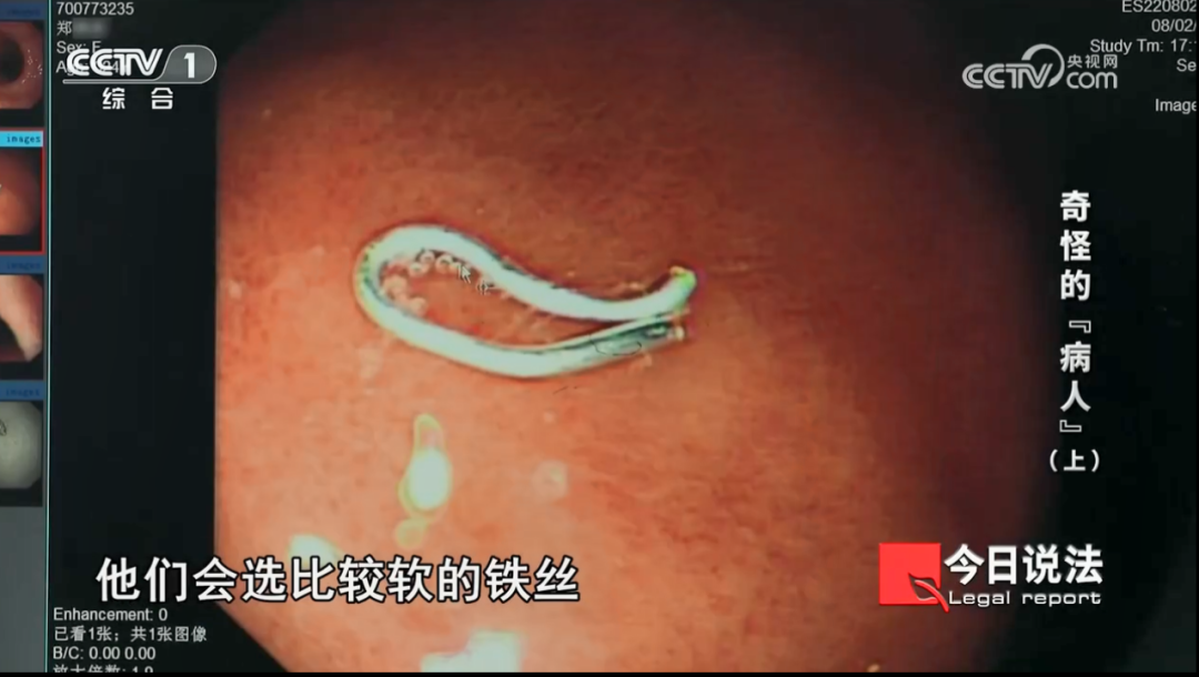 一周内2人在饭店吃到铁丝就诊!医生检查发现不对劲…… 一周内2人在饭店吃到铁丝就诊!医生检查发现不对劲……